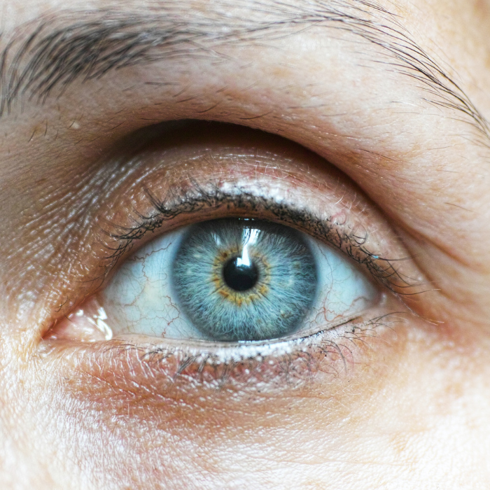 Laser Terapia Selettiva Glaucoma
