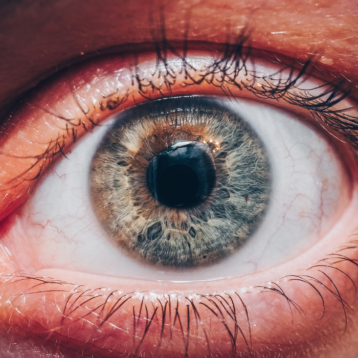 Laser Terapia Selettiva Glaucoma